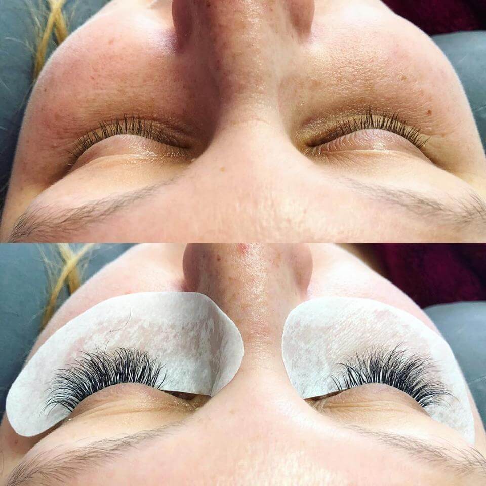 Top view of a person's closed eyes, showing their natural eyelashes in the upper part of the image and their eyes with long, full eyelash extensions and protective pads underneath in the bottom part of the image. The skin is slightly freckled.